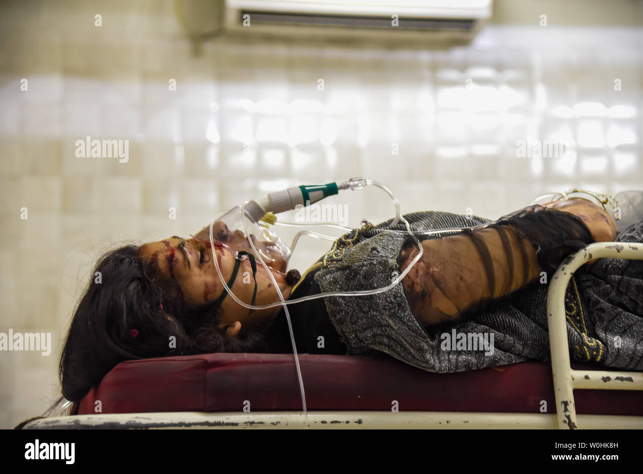 (EDITORS NOTE: Image contains graphic content.) An injured woman seen getting treatment inside a hospital in Srinagar. Eleven students including nine girls died and several other injured after a mini Bus carrying students to an excursion fell into a gorge on the historic Mughal road in south Kashmir’s Shopian district. Stock Photo