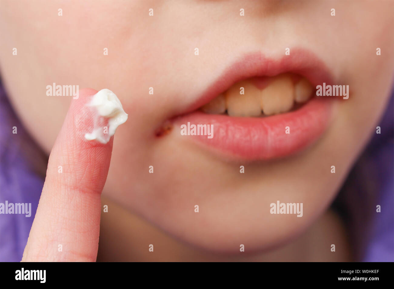 Herpes on lips of child. Treatment ointment. Stock Photo