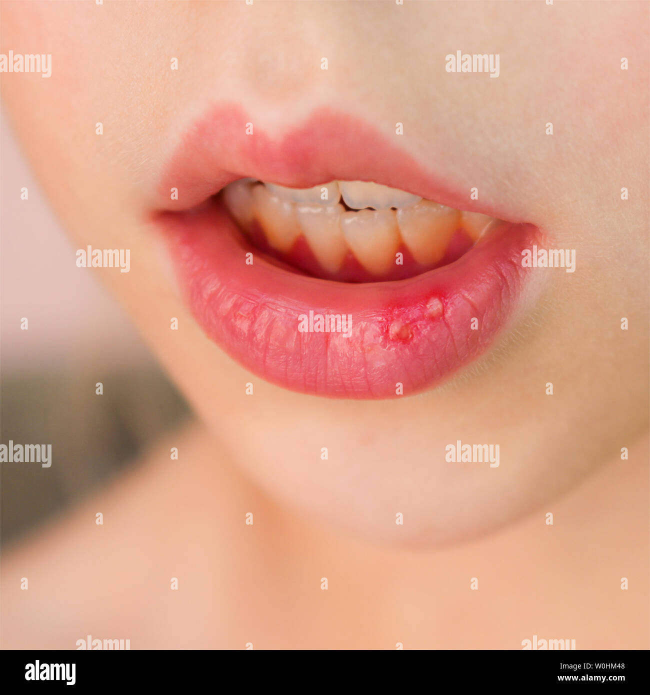 Stomatitis on the lip in child Stock Photo