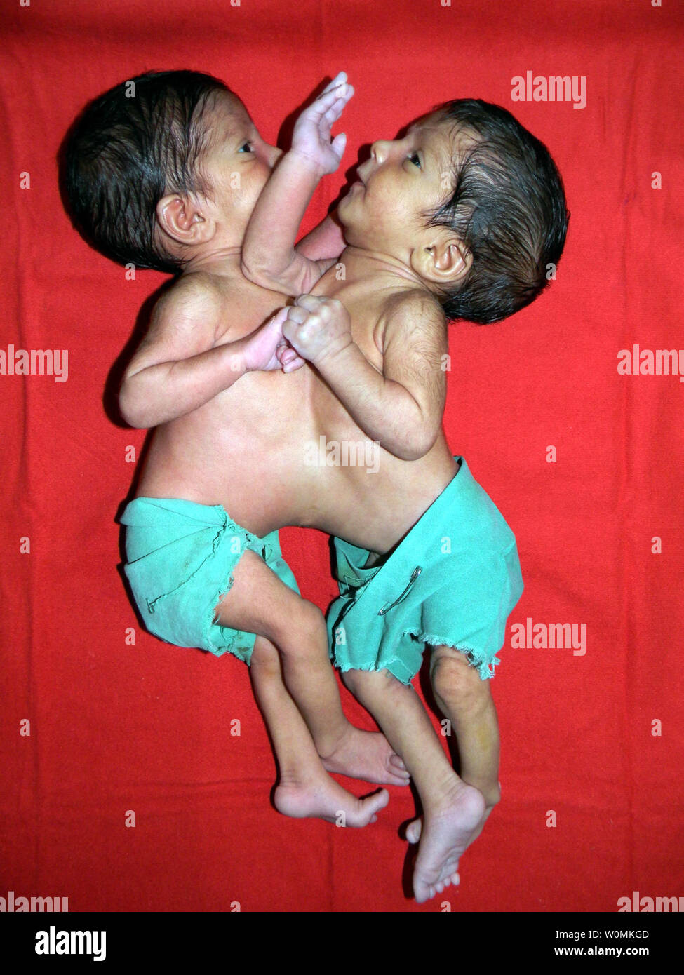 Formerly conjoined twins, Stuti and Aradhana are seen in this pre-operation file photo at Missionary Hospital in Padhar, Betul, in central India. The one-year-olds were successfully separated after a 12-hour surgery on June 20, 2012, conducted by a team of 34 medical experts, including 23 doctors, drawn from India and abroad.The one-year-old sisters were joined at heart and liver.            UPI Photo/ STR.                               . Stock Photo
