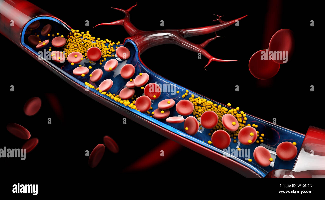 3d Illustration of blood cells with plaque buildup of cholesterol Stock