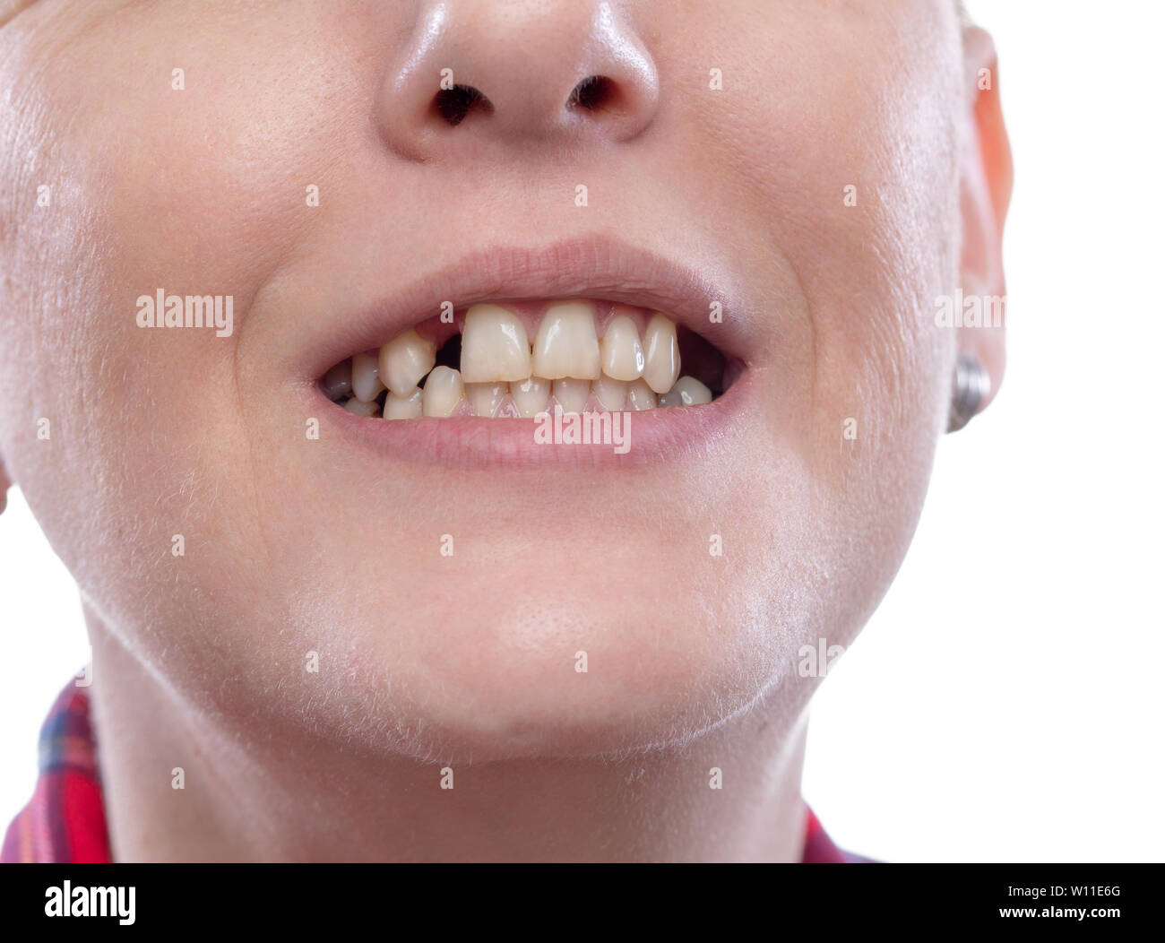 Tooth pain and dentistry, broken teeth young woman broken teeth