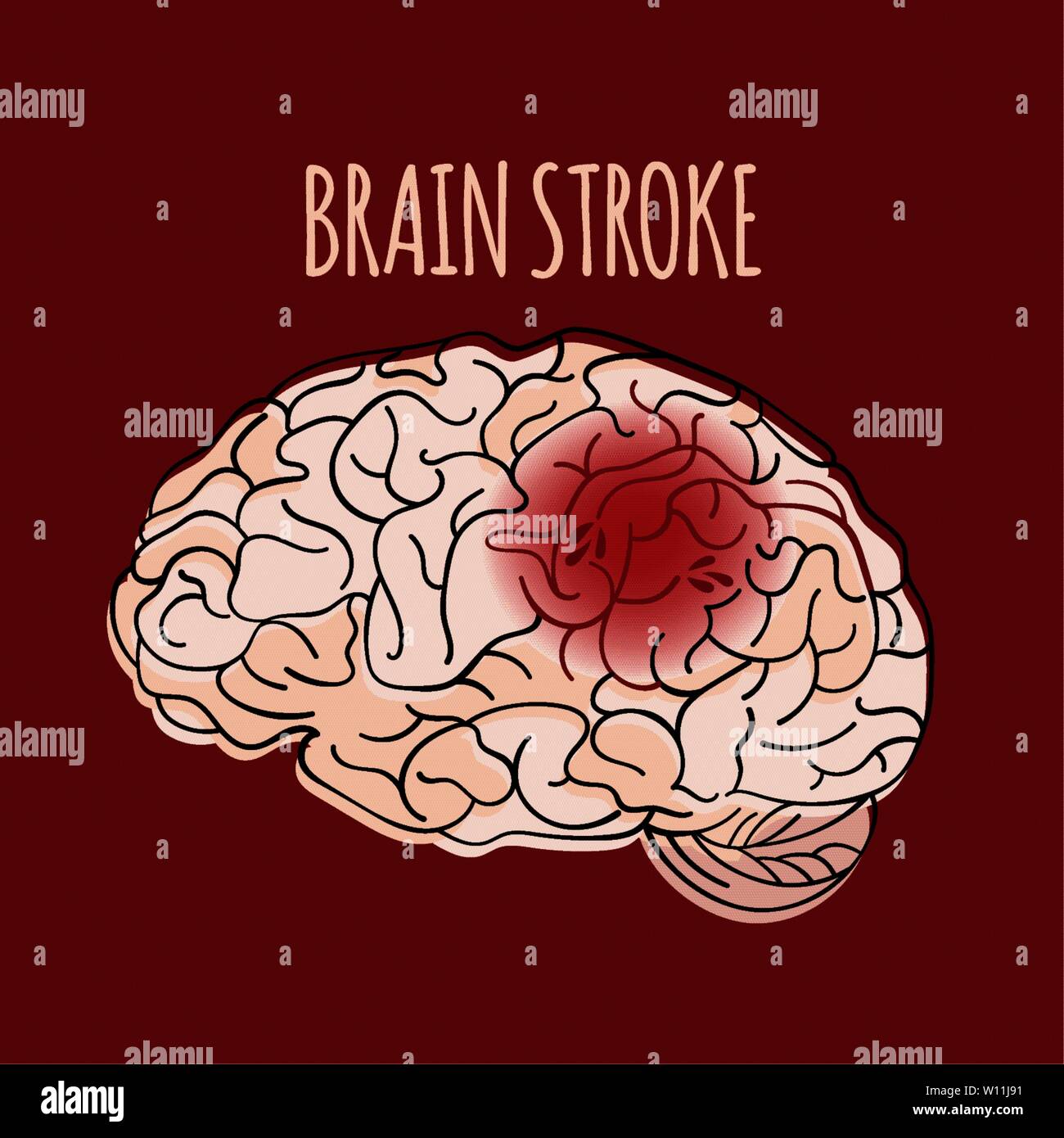 Brain Stroke Insult Apoplexy Medicine Health Danger Treatment