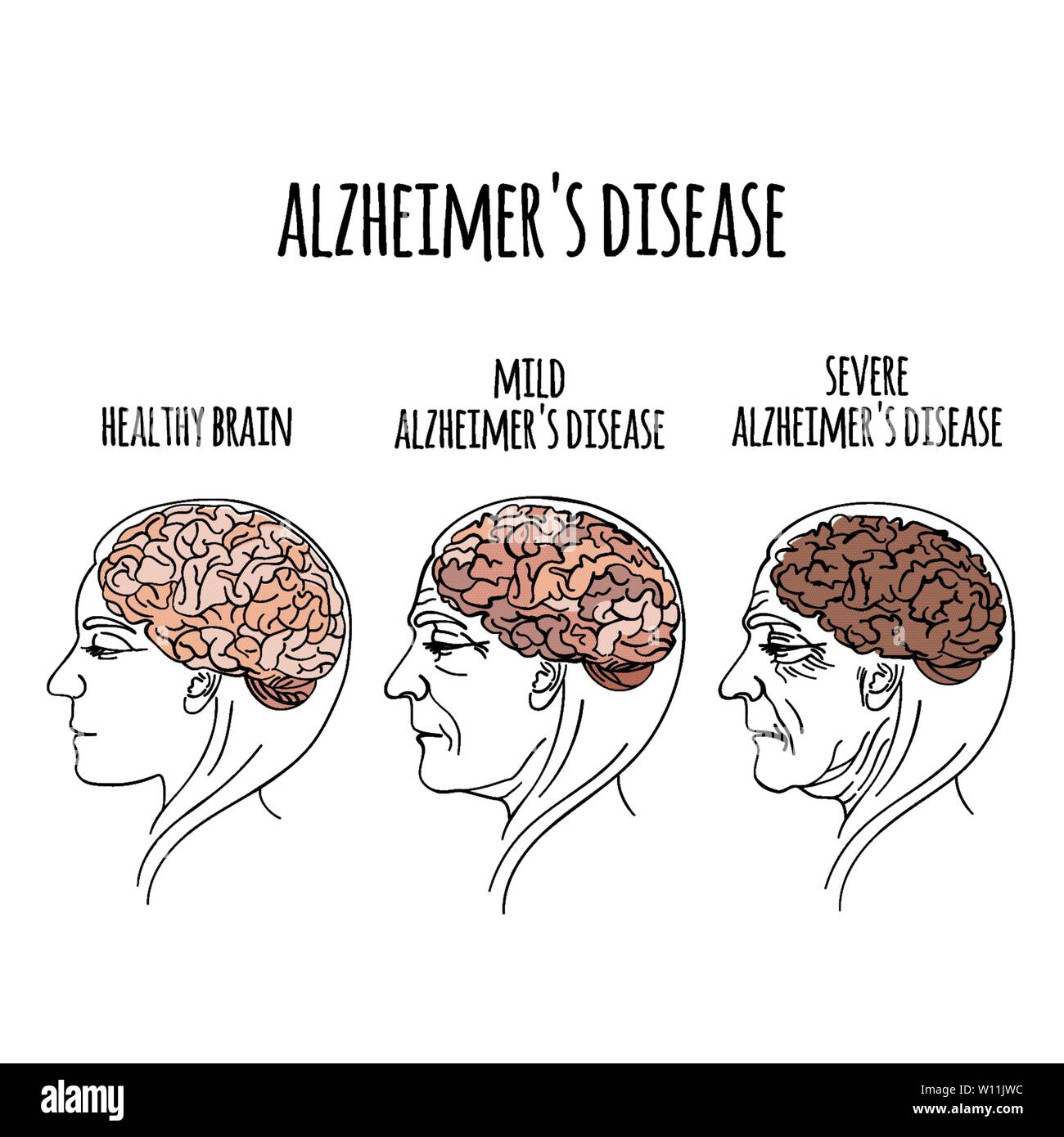 List 104+ Pictures Alzheimer S Disease Pictures Excellent 10/2023
