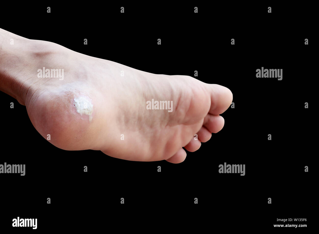 close up pain foot corn isolated on black background with clipping path Stock Photo Alamy