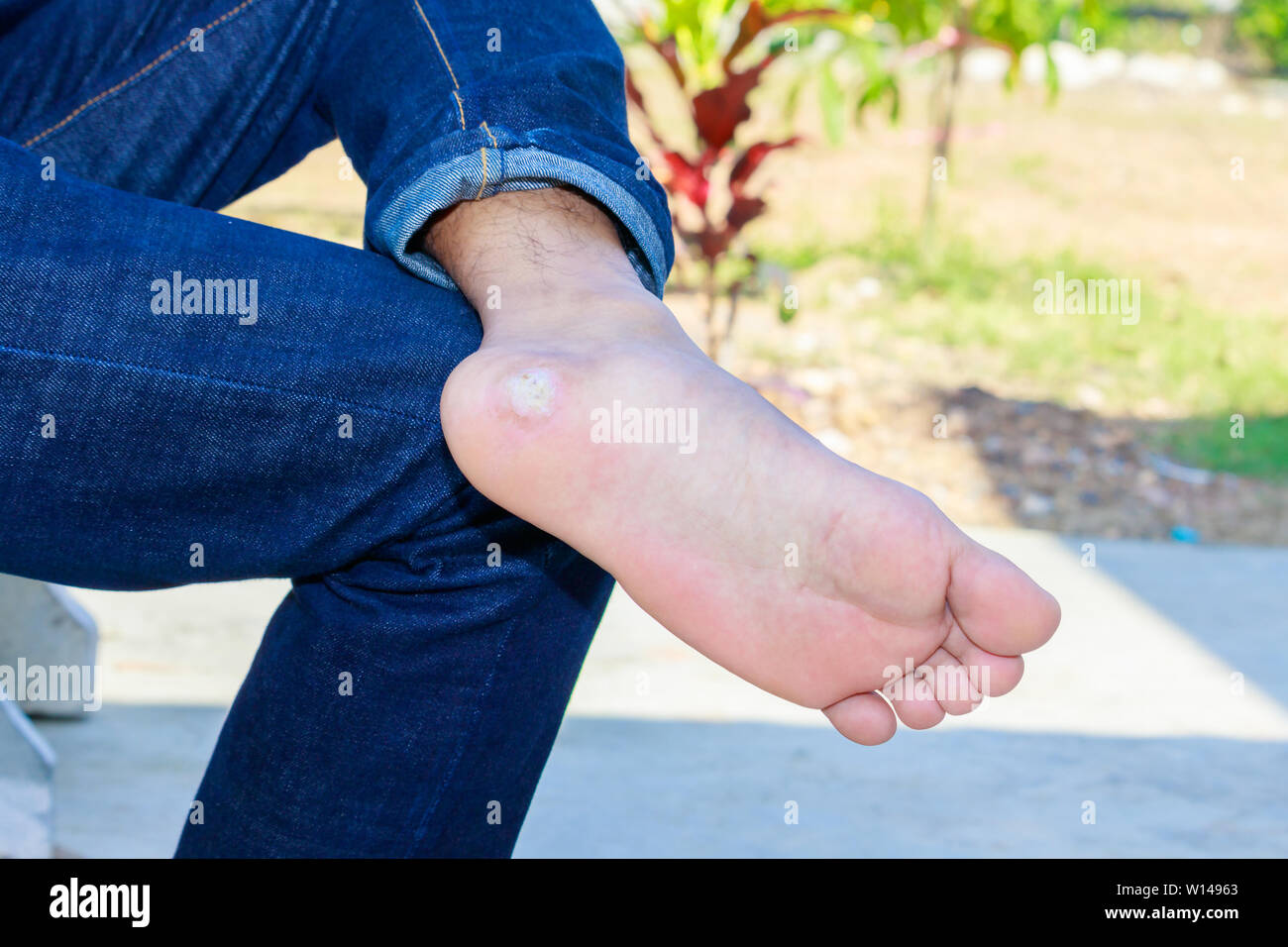close up pain foot corn isolated on black background with clipping path Stock Photo Alamy
