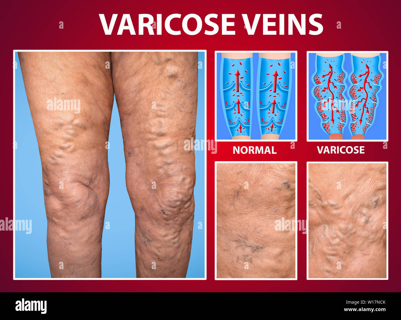 The varicose veins on a legs of woman Stock Photo Alamy
