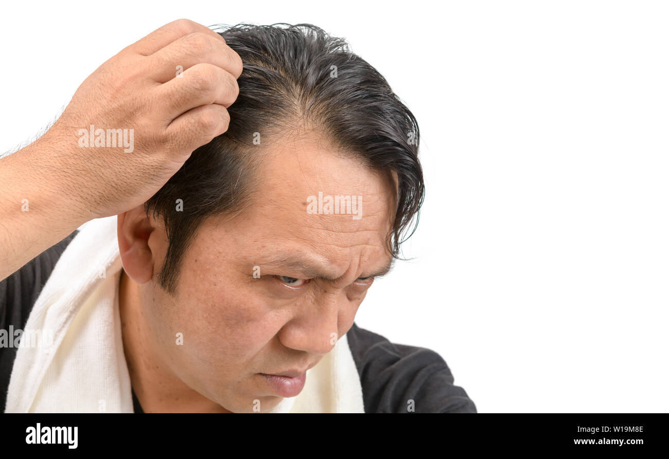 Middle Aged Asian Man Worry About His Hair Loss Or Alopecia