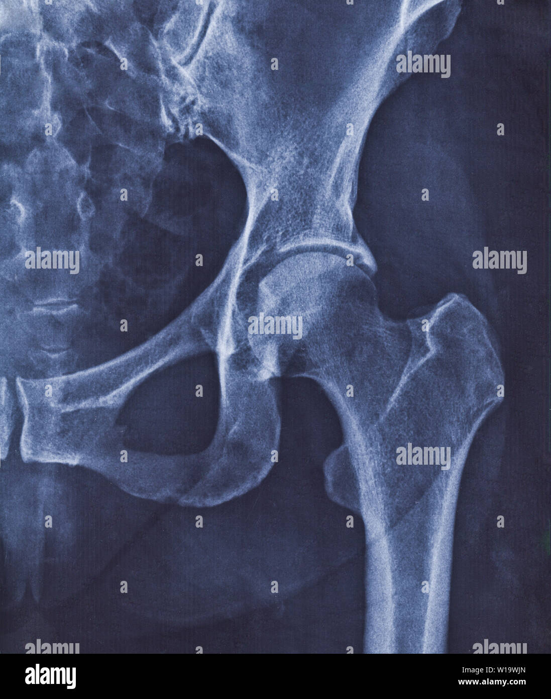 Hip Joint High Resolution Stock Photography and Images Alamy