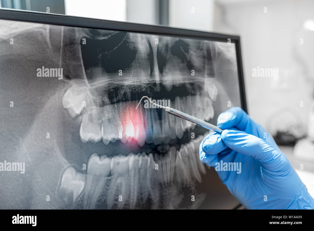 Doctor looking at human teeth x-ray on computer monitor. Modern dental clinic. Stock Photo