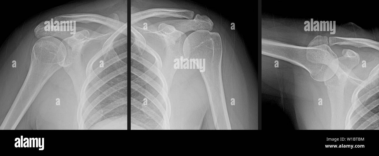 X-ray series of a human shoulder joint showing the humerus bone of the upper arm, the clavicle (collar bone), scapular (shoulder blade), and rib cage. Stock Photo