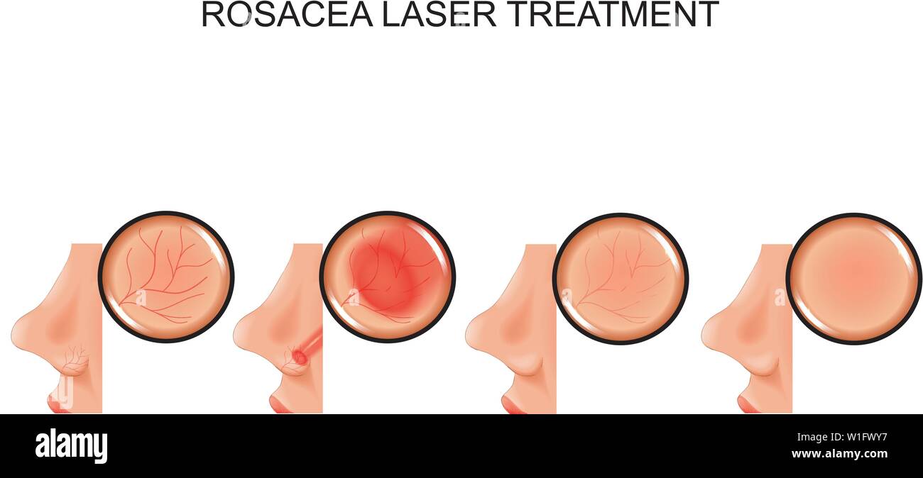 vector illustration of laser treatment of rosacea Stock Vector
