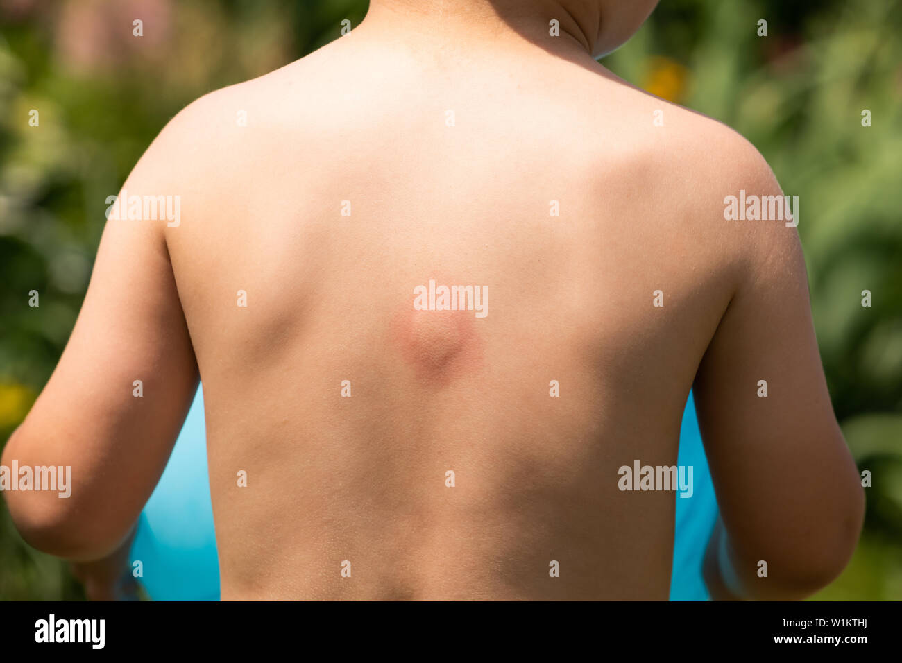 Description: Large swollen insect bite mark on baby's back Stock Photo