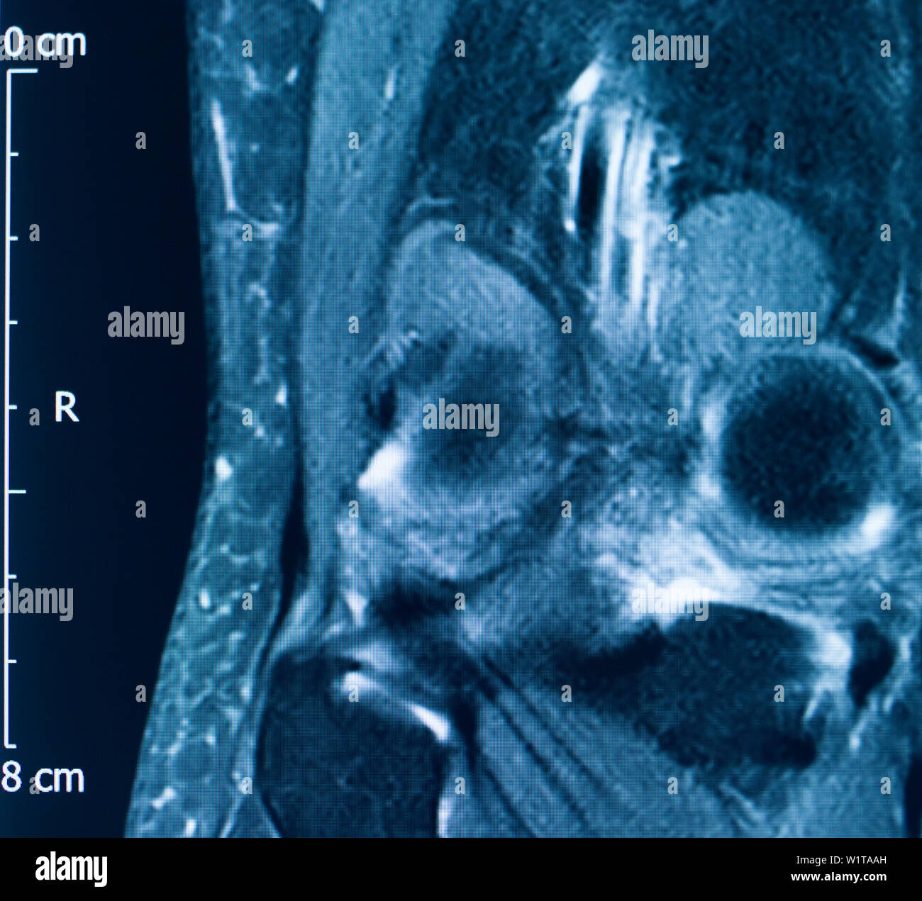 Knee sports injury mri mcl grade 2 tear resonance imaging