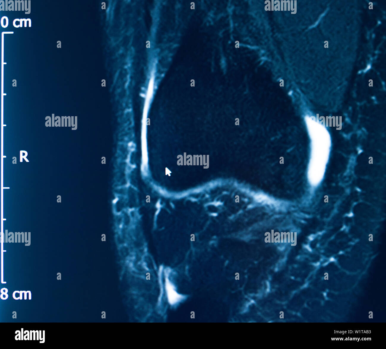 Knee sports injury mri mcl grade 2 tear resonance imaging