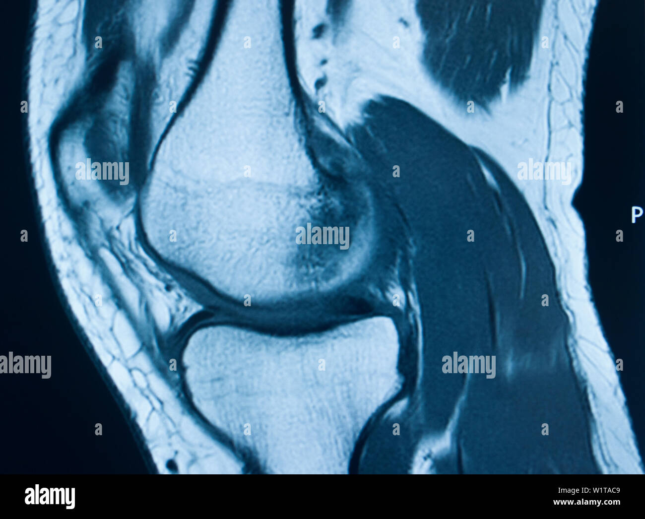 Knee sports injury mri mcl grade 2 tear magnetic resonance imaging ...