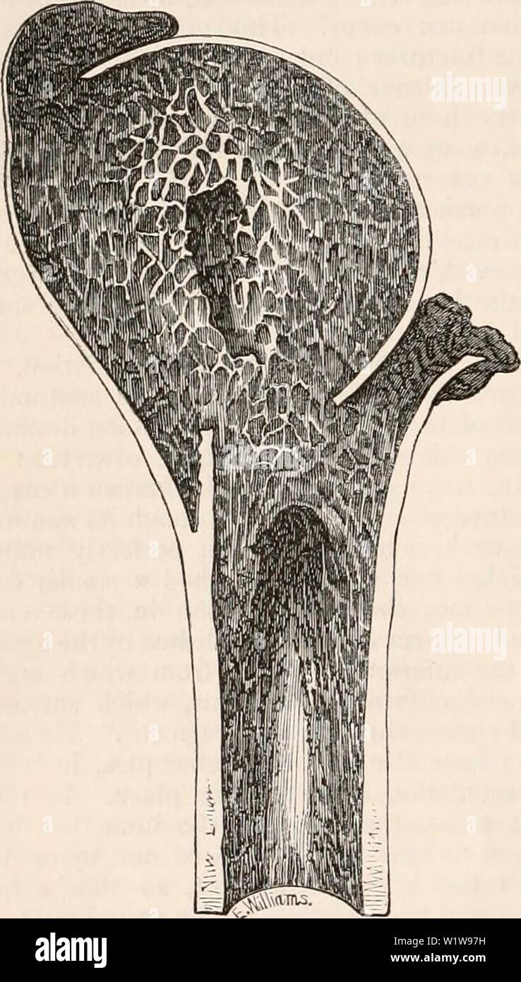 Archive image from page 623 of The cyclopædia of anatomy and. The cyclopædia of anatomy and physiology  cyclopdiaofana0401todd Year: 1847 602 ABNORMAL CONDITIONS OF THE SHOULDER JOINT. fully examined. The arm was slightly short- ened. The contour of the shoulder was not as full nor as round as that of its fellow, and the acromion process was more prominent than natural. Upon opening the capsular ligament, the head of the humerus was found to have been driven into the cancellated tis- sue of the shaft, between the tuberosities, so deeply as to be below the level of the summit of the great tuber Stock Photo