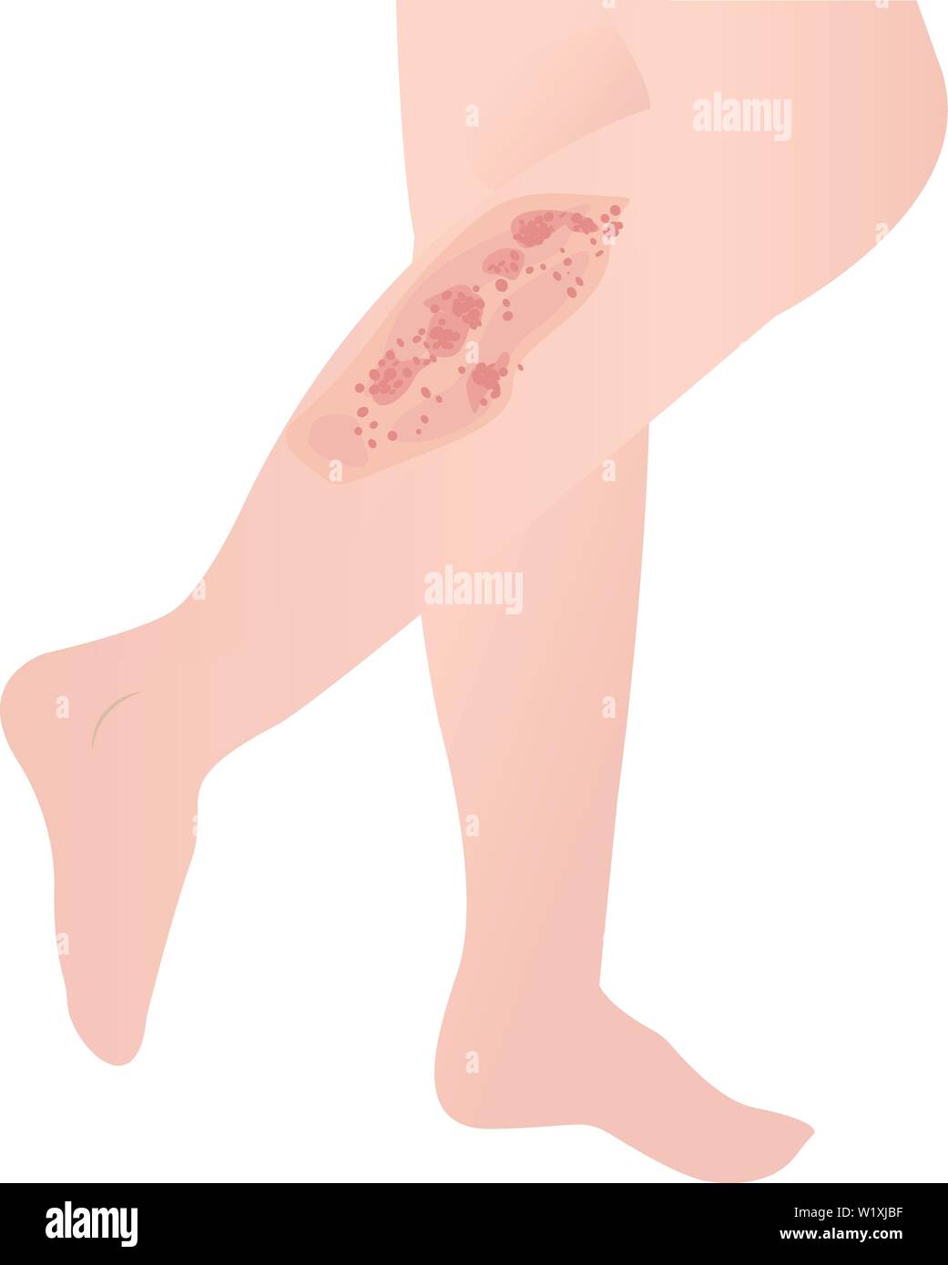 Psoriasis human body skin Stock Vector Images - Alamy