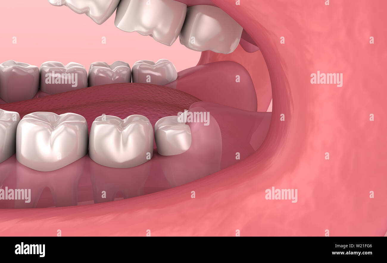 Tooth Defects Animation Tooth fracture hi-res stock photography and images - Alamy
