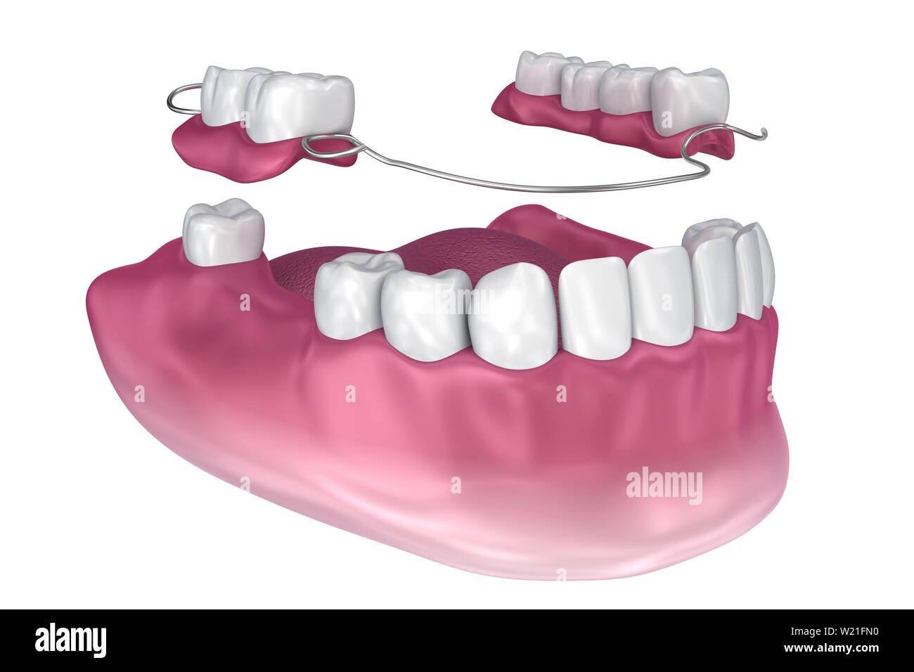 Removable partial denture. Medically accurate 3D illustration Stock