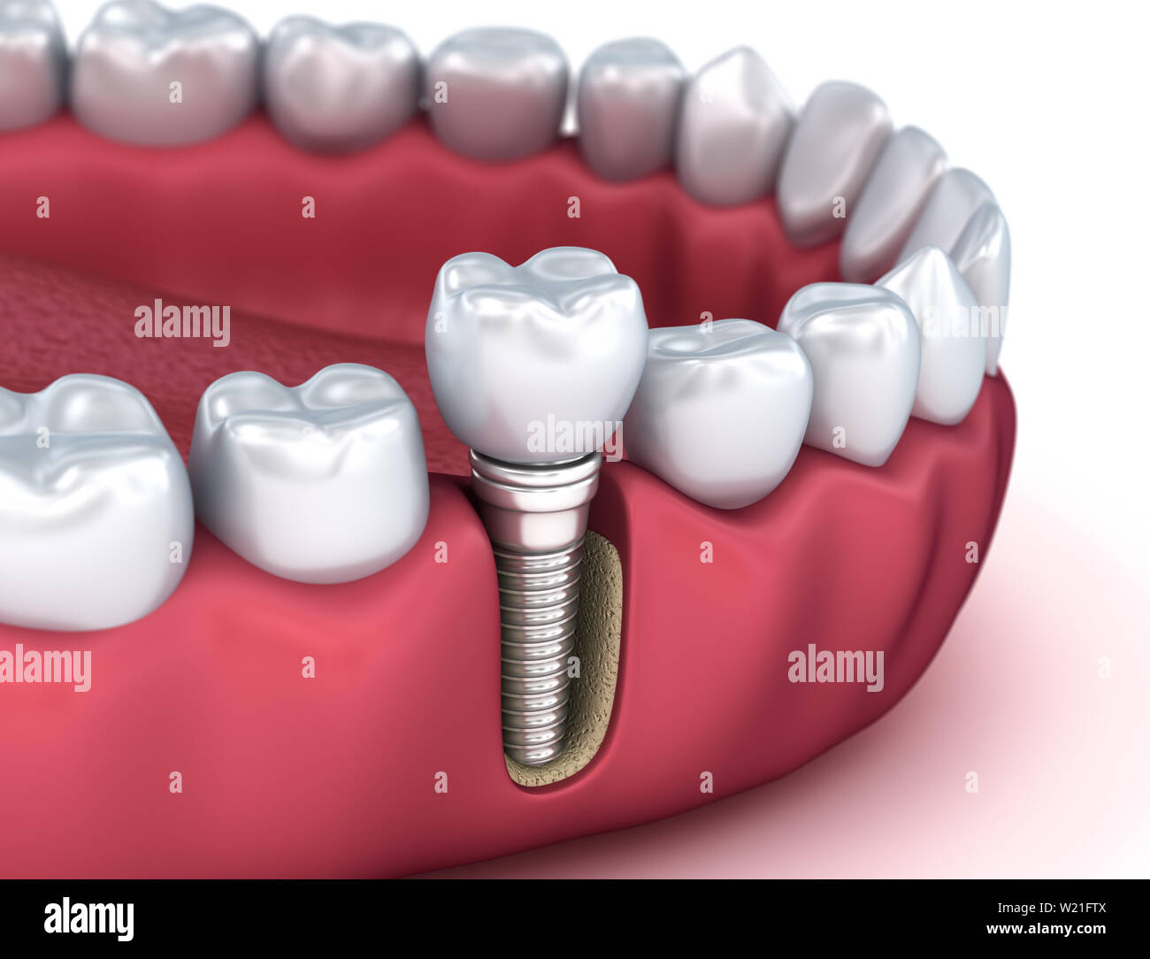 Tooth implant instalation process , Medically accurate 3D illustration