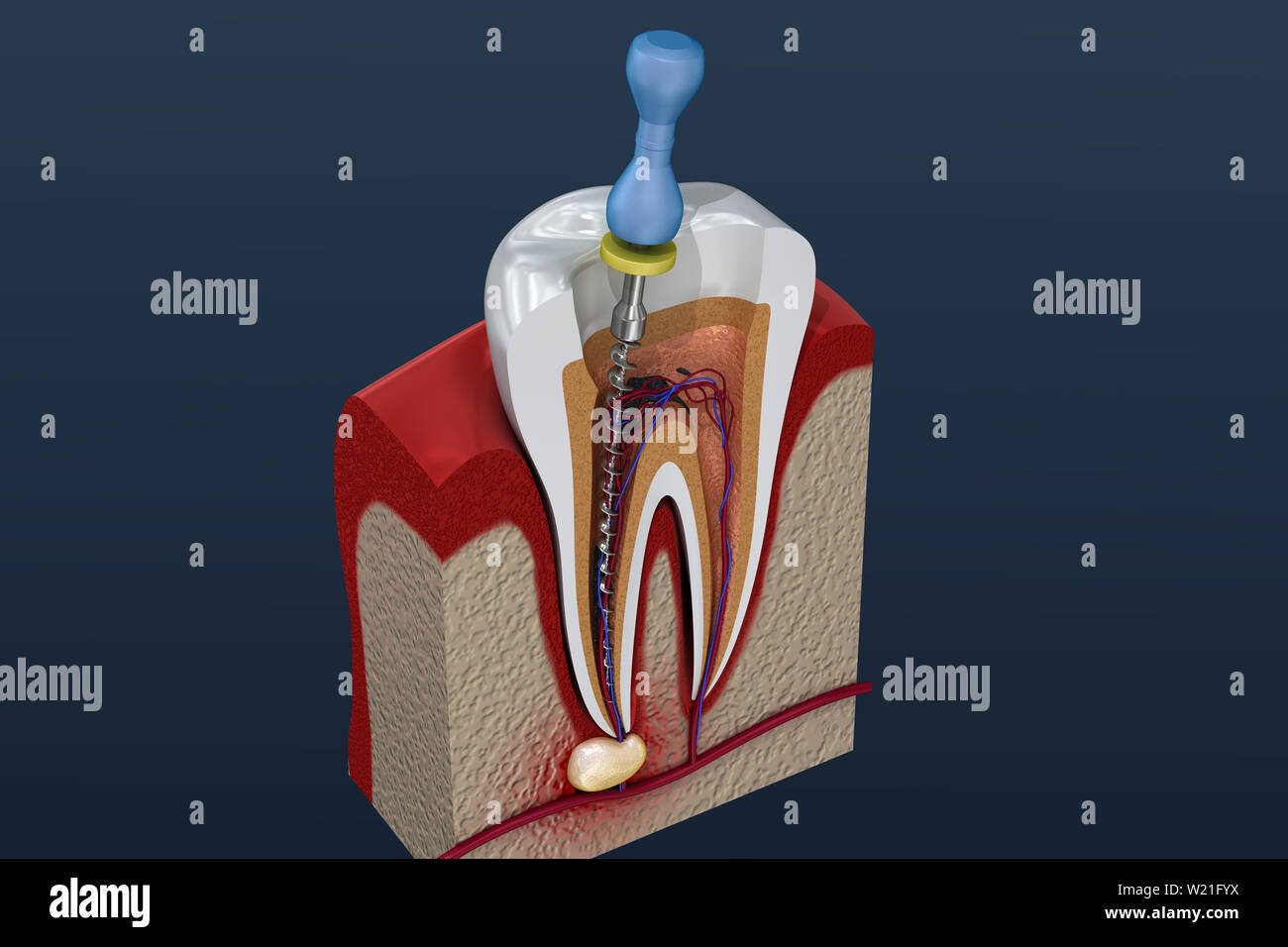 Root canal treatment process. 3D illustration Stock Photo