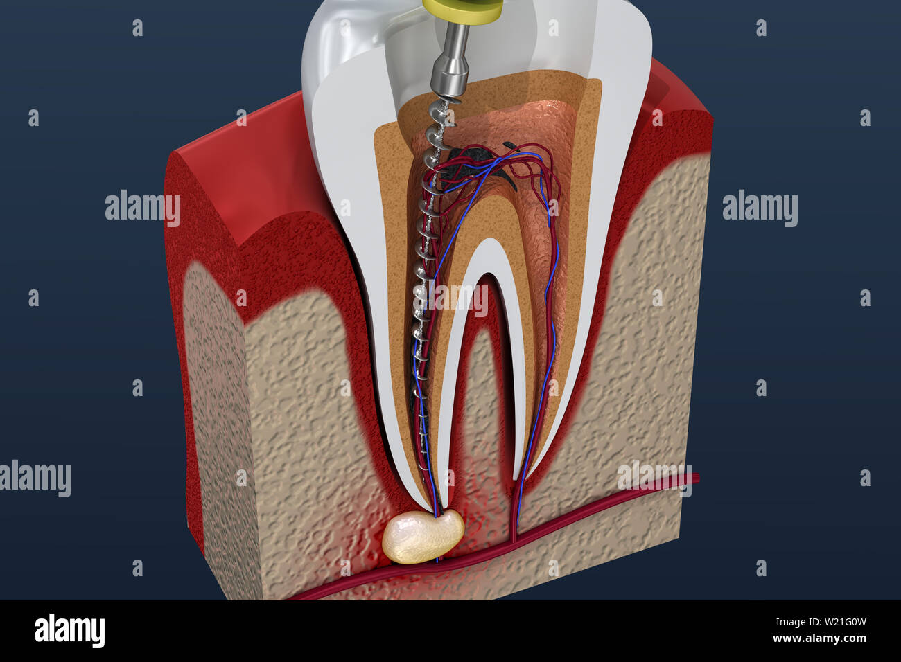 Root canal treatment process. 3D illustration Stock Photo