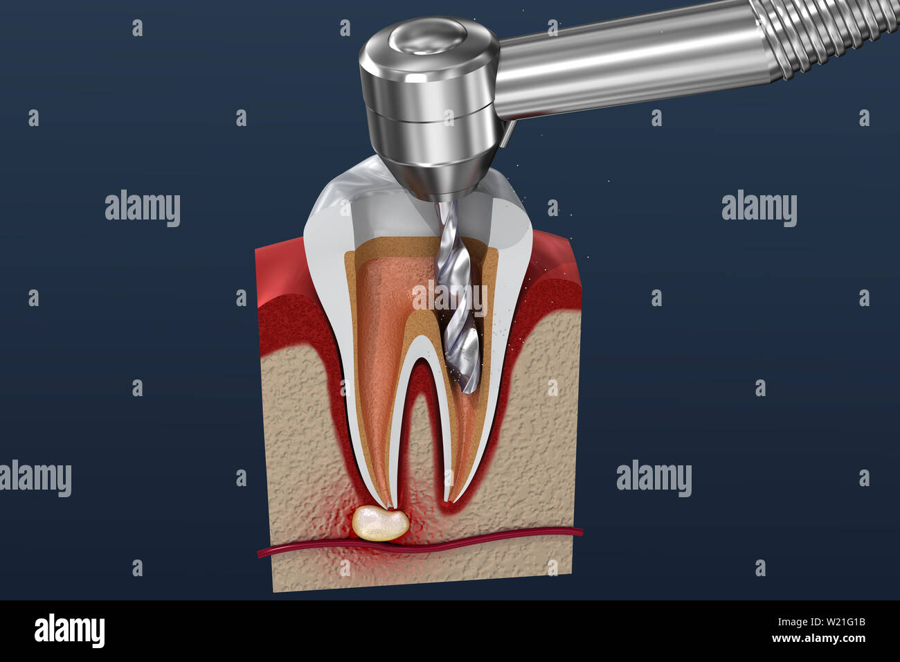 Tooth with temporary filling for nerve destruction and pulpitis treatment.  Stomatology Stock Photo - Alamy