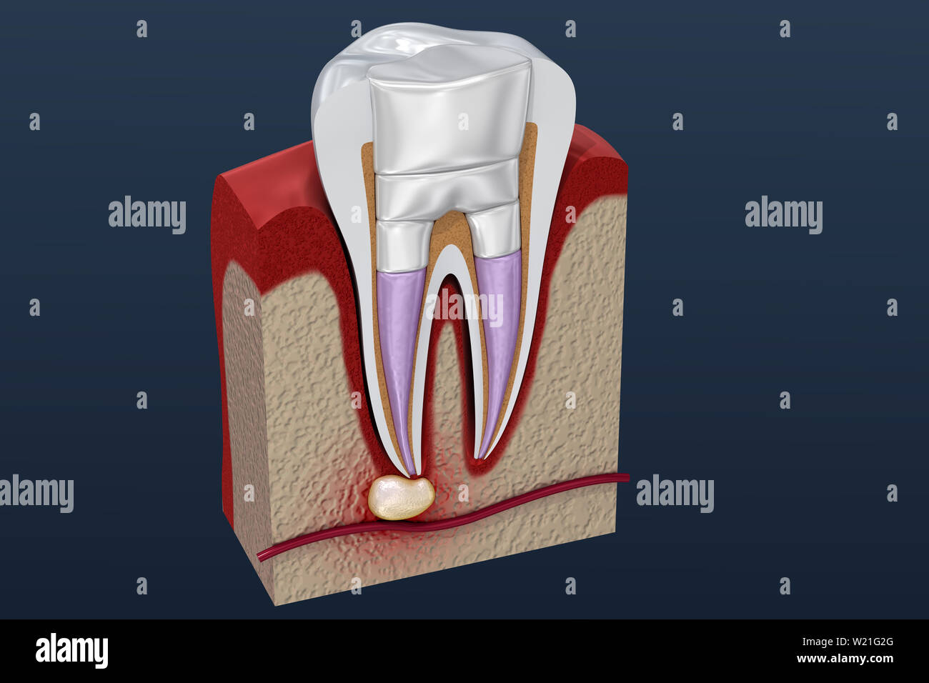 Dental fillings procedure diagramm . 3D illustration Stock Photo Alamy