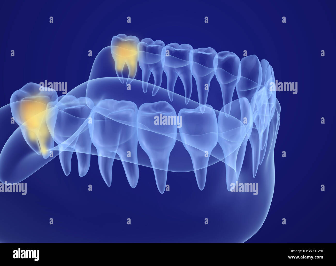 Wisdom tooth xray view. Medically accurate tooth 3D illustration Stock