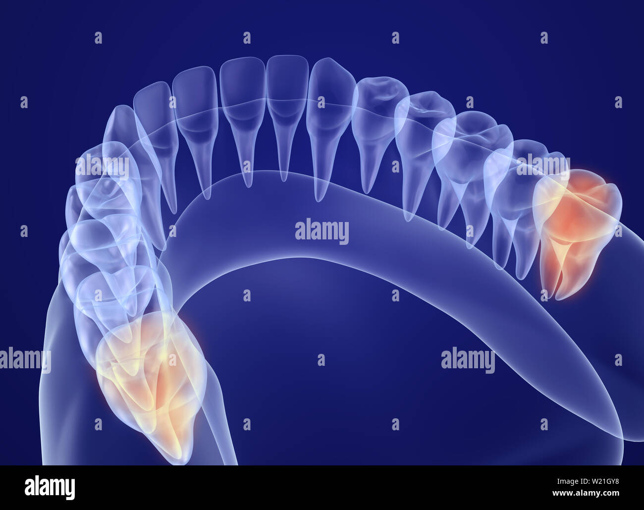 Wisdom tooth xray view. Medically accurate tooth 3D illustration Stock
