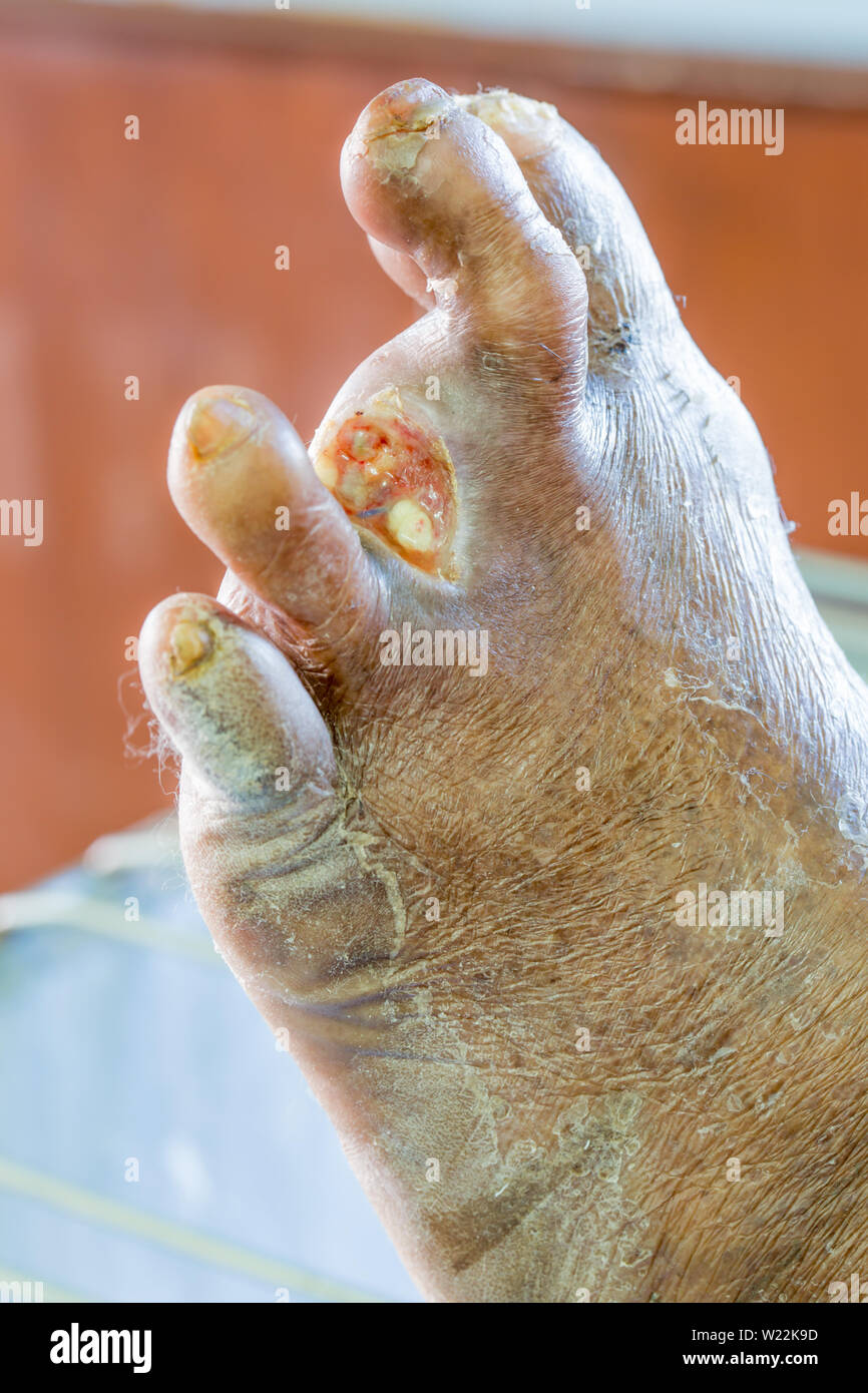 Infected wound of diabetes foot Stock Photo
