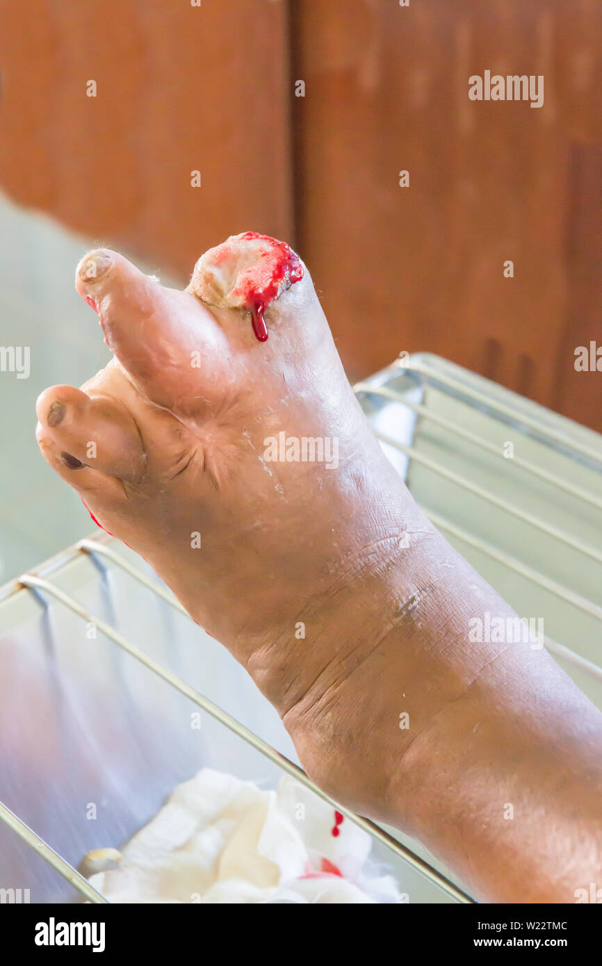 infected wound of diabetic foot Stock Photo