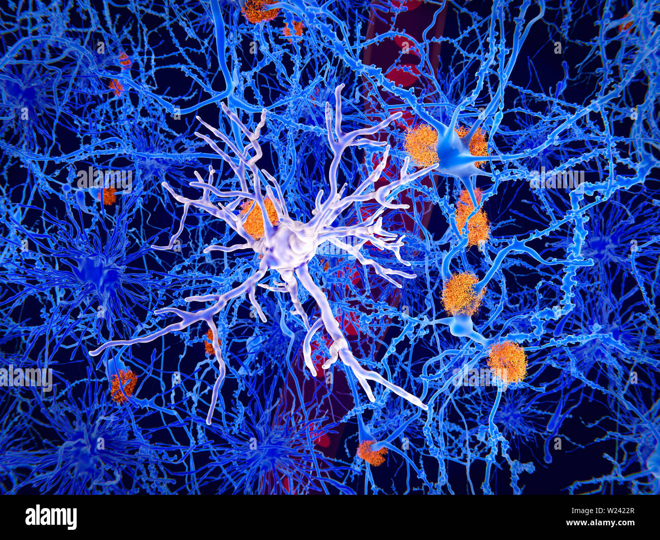 Amyloid and microglia cell in Alzheimer's disease. Illustration of