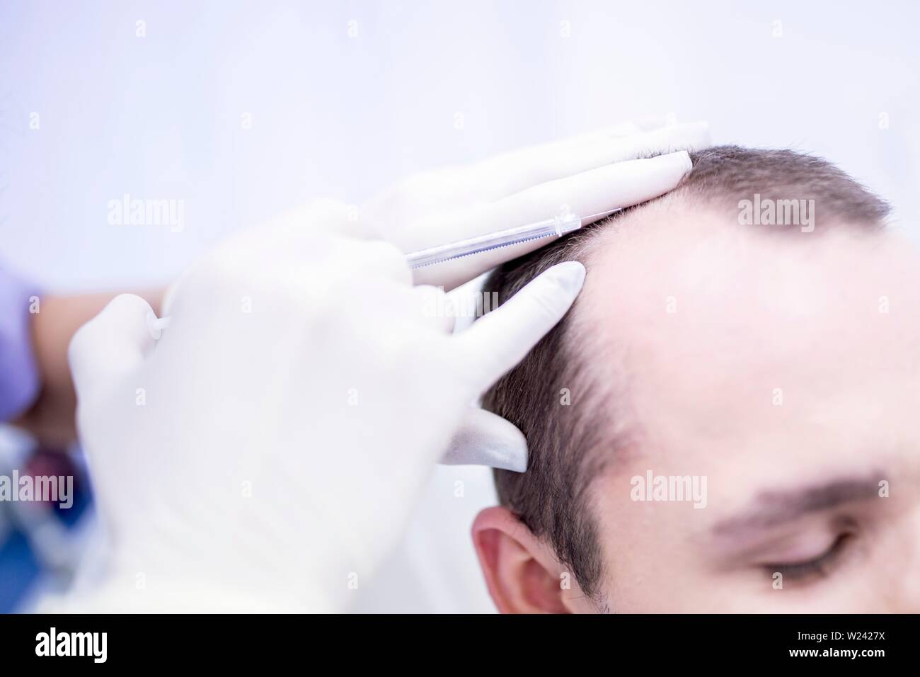 Young man having plasma re-application in scalp for trichology treatment, close-up. Stock Photo