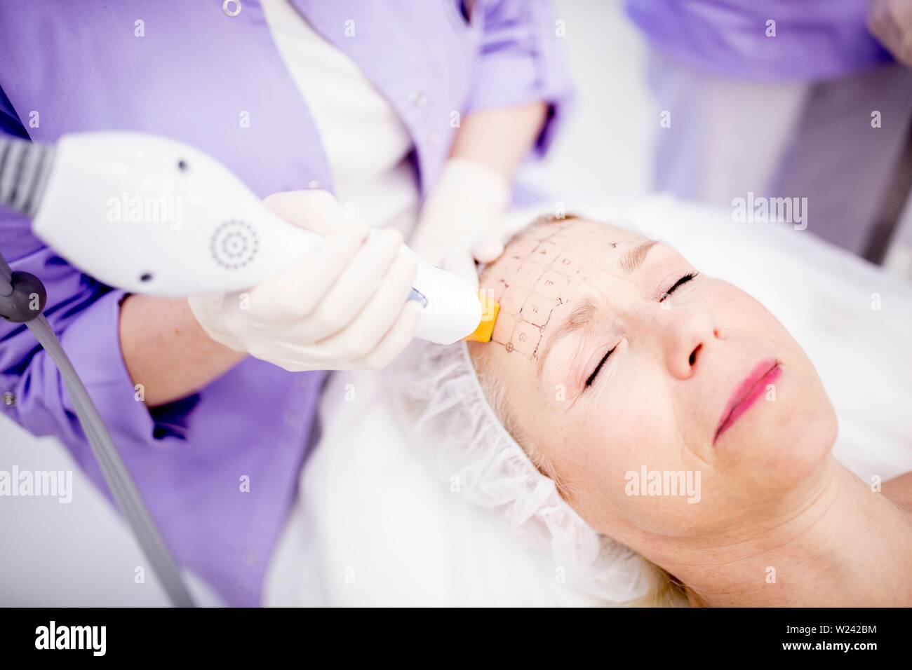 Dermatologist giving thermage treatment to mature woman's forehead to soften wrinkles. Stock Photo