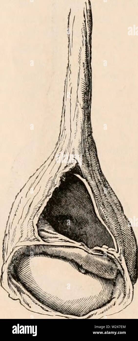 Archive image from page 212 of The cyclopædia of anatomy and. The cyclopædia of anatomy and physiology  cyclopdiaofana0402todd Year: 1849  TESTICLE (ABNORMAL ANATOMY). 997 hydrocele, in which the testicle is retained in the abdomen or inguinal canal, while the peritoneum, prolonged for a short distance into the scrotum, forms the cyst containing the fluid which is covered only by the inte- guments and superficial fascia. Encysted hydrocele of the testicle. — In this form of hydrocele, fluid is effused into an ad- ventitious cyst or cysts distinct from the sac of the tunica vaginalis. The cyst Stock Photo