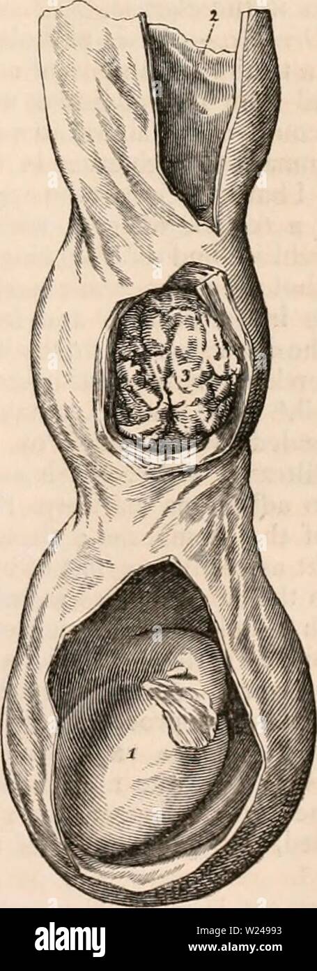 Archive image from page 218 of The cyclopædia of anatomy and. The cyclopædia of anatomy and physiology  cyclopdiaofana0402todd Year: 1849  structure of the testicle is usually indeed sound in haematocele, but its nutrition becomes im- paired when the disease is of very old stand- ing. Encysted hcematocele of the testicle, or effusion of blood in a cyst connected with the testicle, is an extremely rare affection. The following is the only case of the kind that I have met with. I was requested by one of my colleagues at the London Hospital to examine a case of painful tumour connected with the l Stock Photo