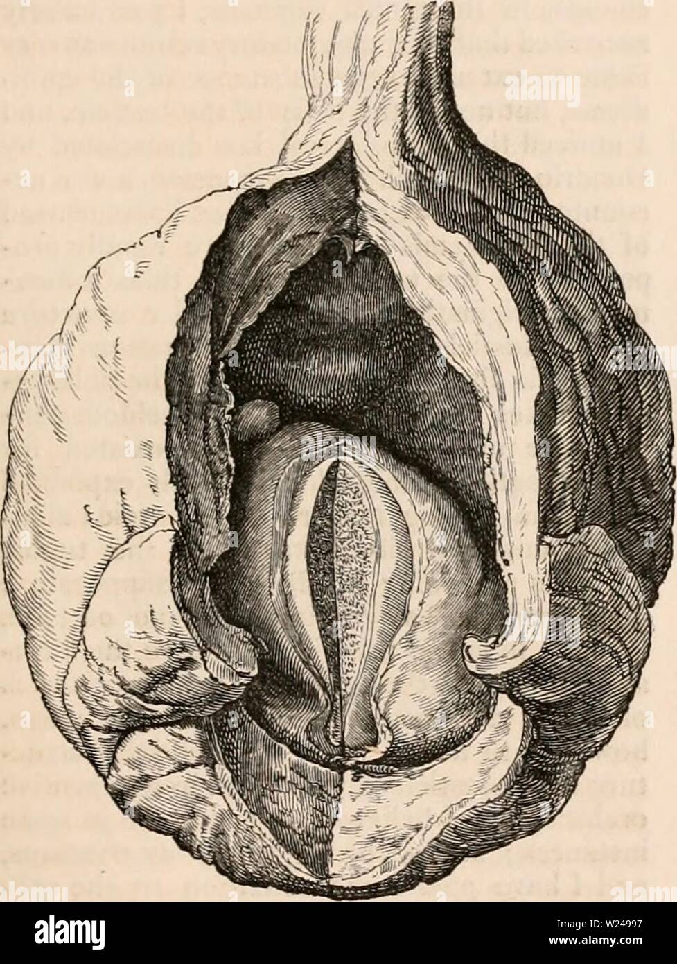 Archive image from page 218 of The cyclopædia of anatomy and. The cyclopædia of anatomy and physiology  cyclopdiaofana0402todd Year: 1849  TESTICLE (ABNORMAL ANATOMY). glandular structure of the testicle sometimes disappears in the same manner as in old cases of hydrocele, atrophy being occasioned by the long continued pressure arising from the ex- travasated blood. Sir B. Brodie has recorded two cases of old hgematocele, in which the testicle was completely atrophied. In the examination of a large hasmatocele which had existed for many years, and was removed by operation, under the impression Stock Photo