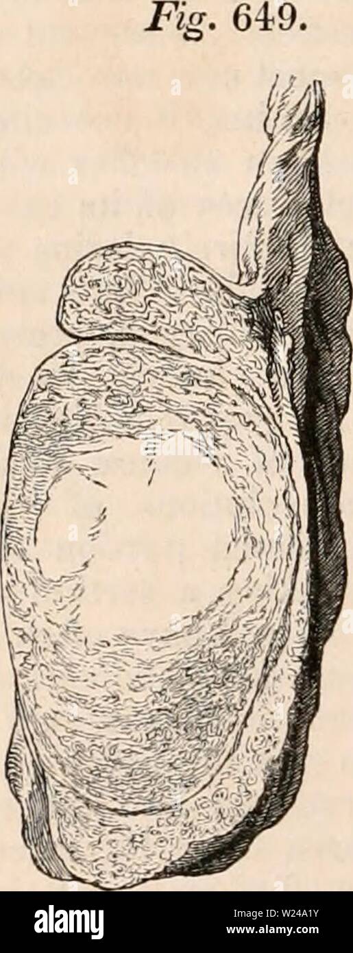 Archive image from page 221 of The cyclopædia of anatomy and. The cyclopædia of anatomy and physiology  cyclopdiaofana0402todd Year: 1849  TESTICLE (ABNORMAL ANATOMY). 1006 epididymis, appears to prevent the oblitera- tion of the duct of which it is composed, and thus accounts for atrophy occurring much more rarely after consecutive orchids than after inflammation originating in the body of the gland, where the delicate seminal tubes are enclosed in the firm unyielding tunica albuginea. Chronic orcftitis. — The testicle is liable to a form of inflammatory swelling of a distinct and chronic cha Stock Photo