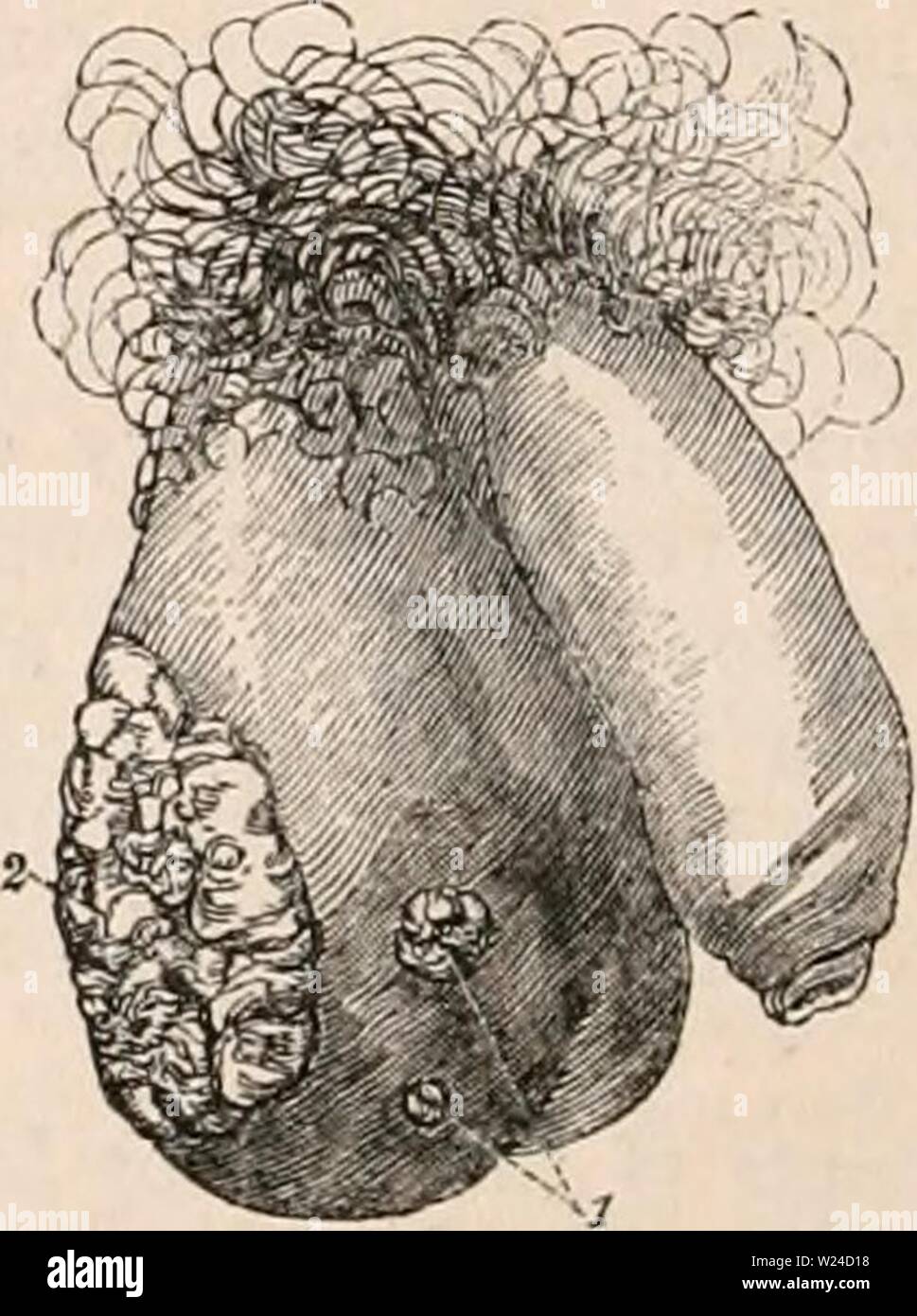 Disease Elephantiasis High Resolution Stock Photography And Images