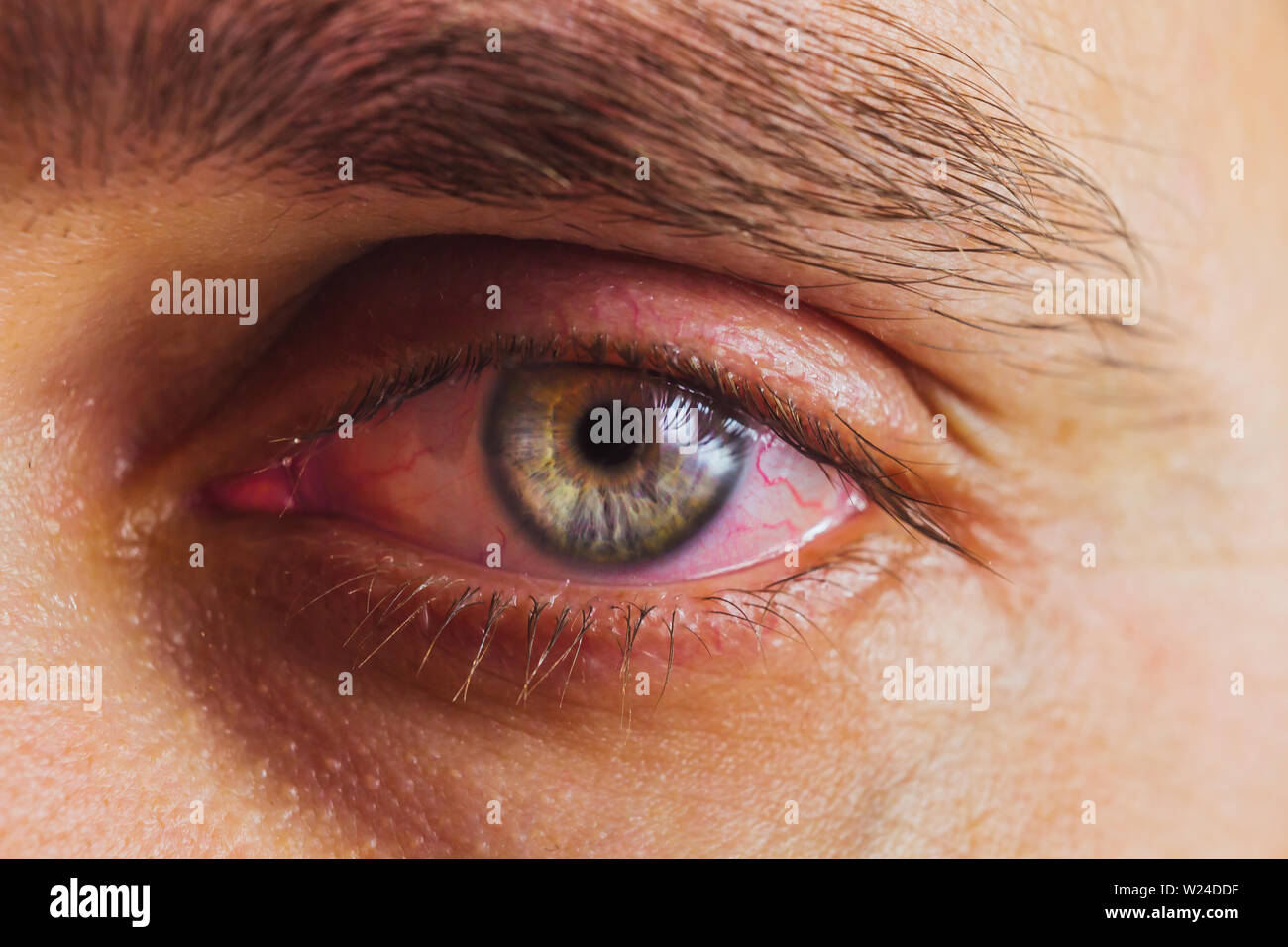 open human eye with bright red arteries close up. irritation and