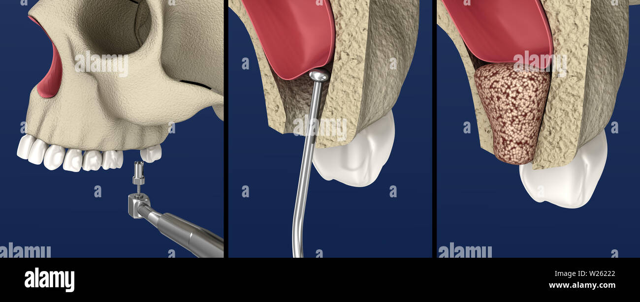 Sinus Lift Surgery - Sinus Augmentation. 3D illustration Stock Photo - Alamy Sinus Lift Surgery - Sinus Augmentation. 3D illustration Stock Photo - Alamy
