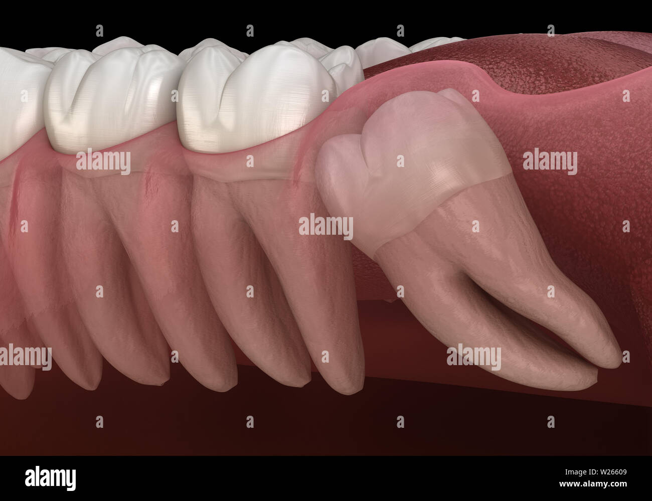 Healthy teeth and wisdom tooth with mesial impaction . Medically accurate tooth 3D illustration Stock Photo