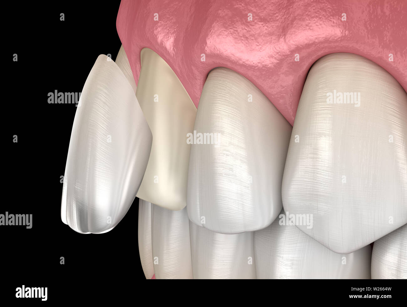 Dental Veneer Central Incisor Veneer Installation Procedure