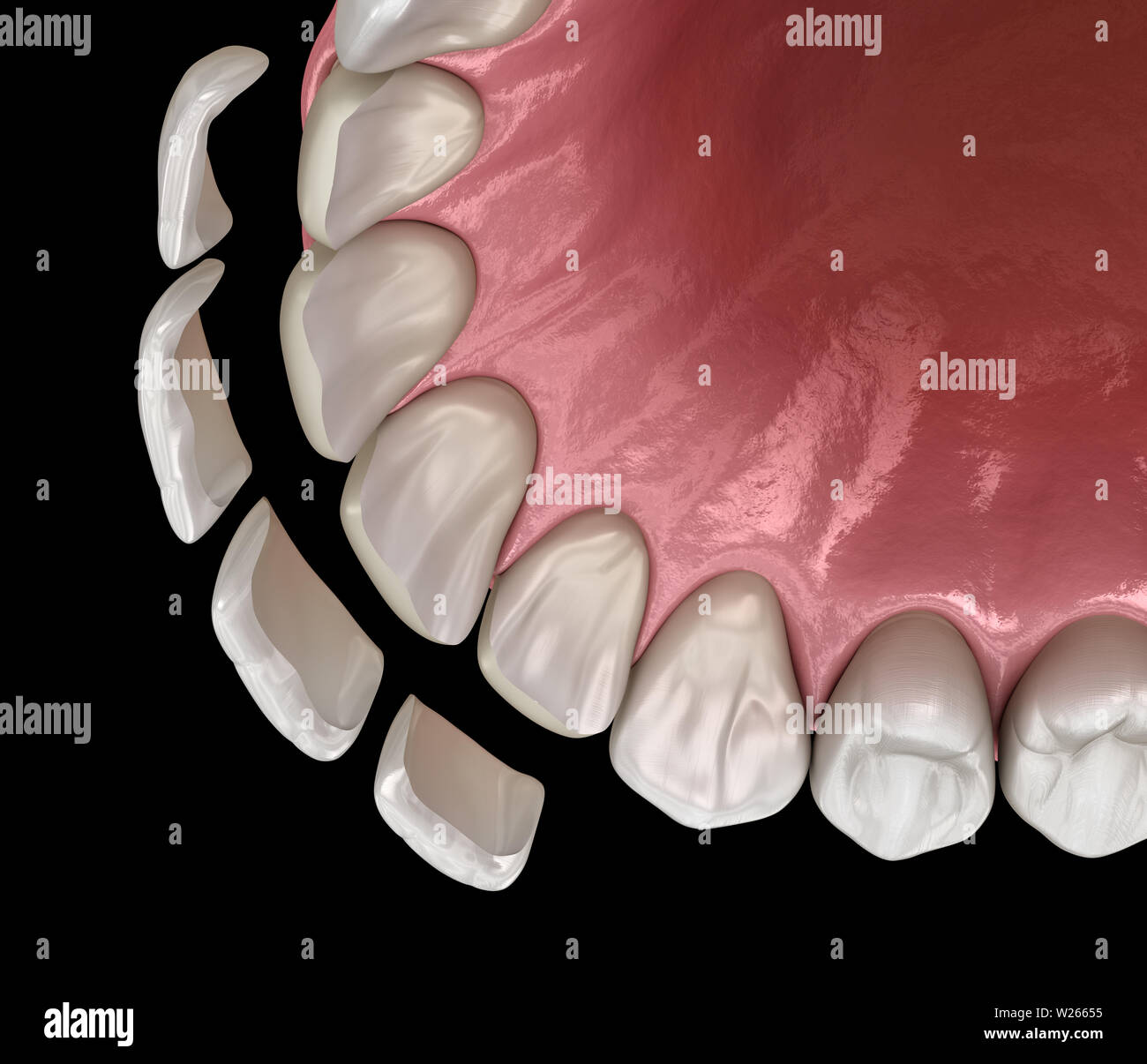 Veneer installation procedure over central incisor and lateral incisor