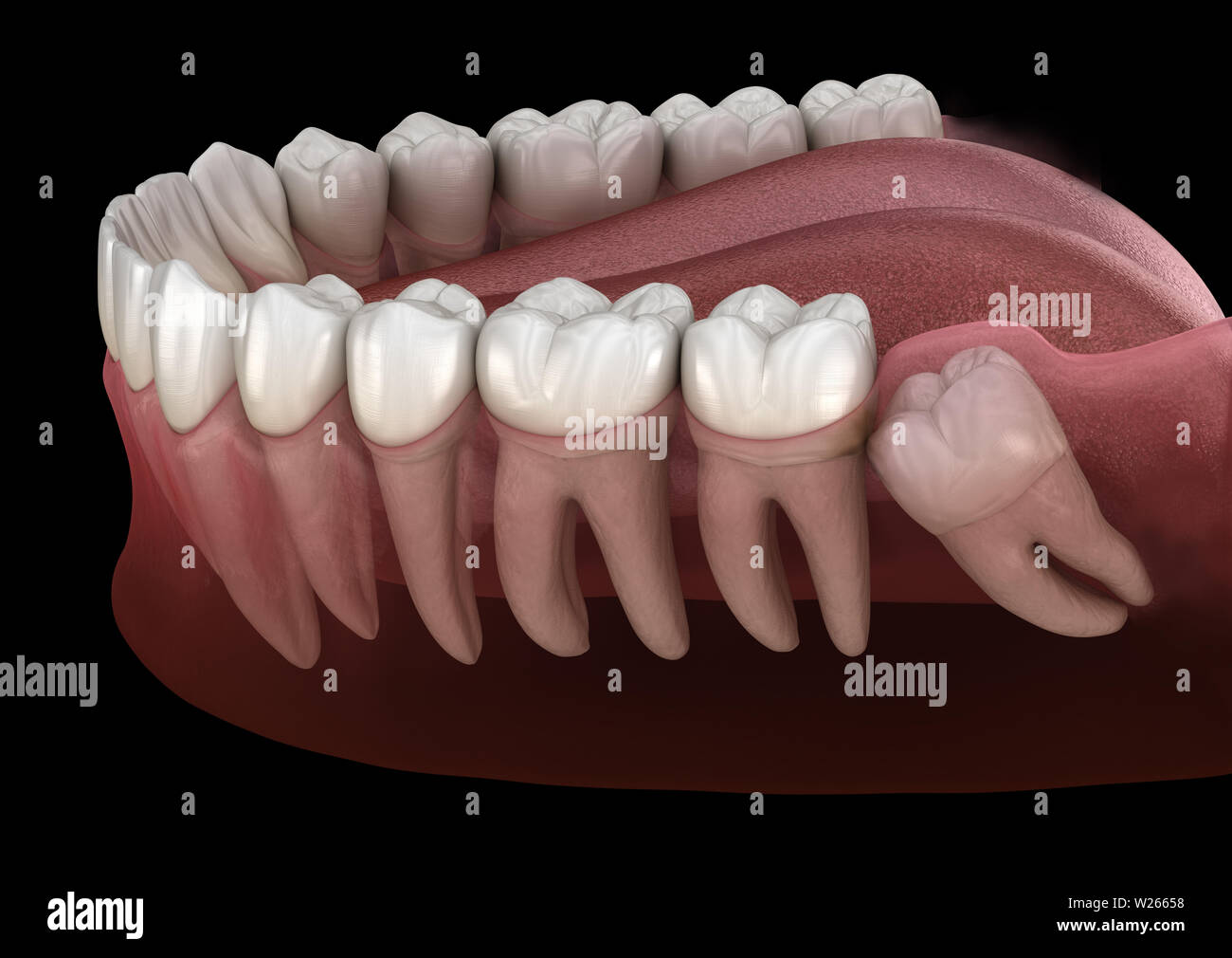 Healthy teeth and wisdom tooth with mesial impaction . Medically accurate tooth 3D illustration Stock Photo