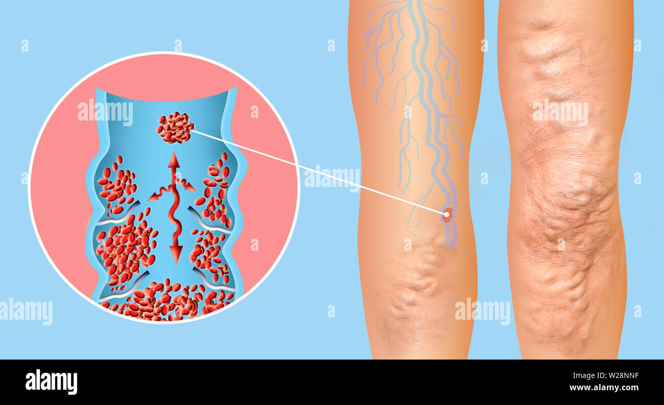 Deep Vein Thrombosis or Blood Clots. Embolus. Structure of normal and