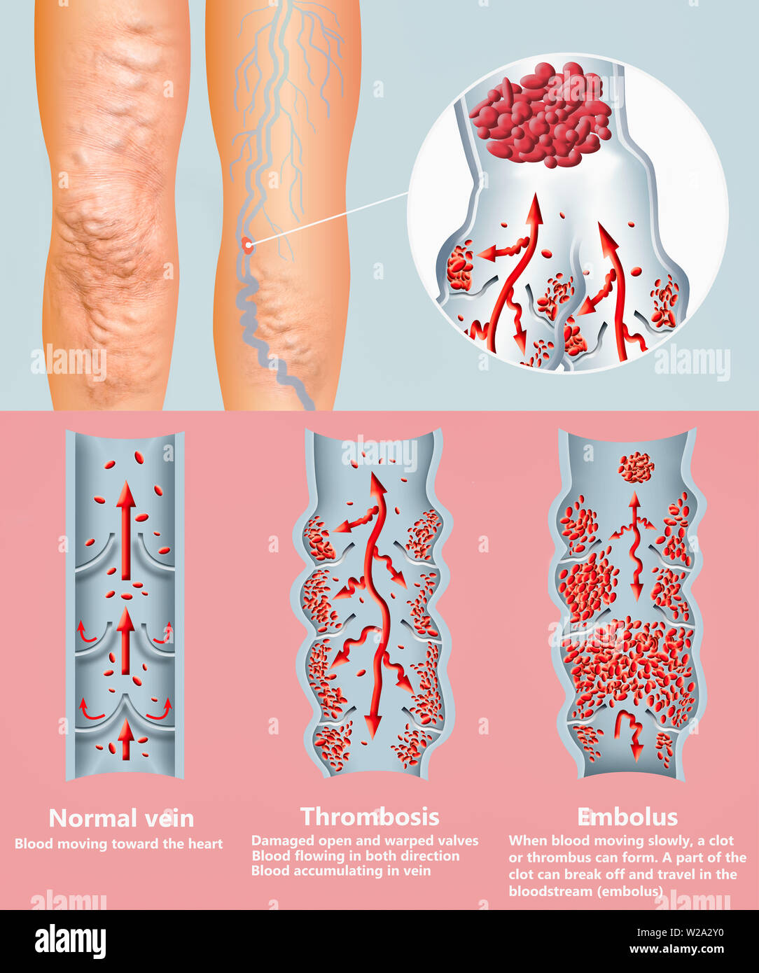 Thrombosis Deep Vein