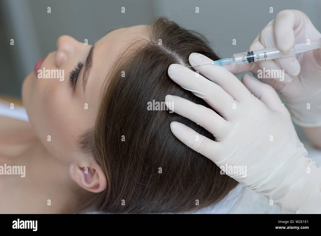 treatment of hair loss, injection for hair growth. Injected in woman's head, hair mesotherapy Stock Photo